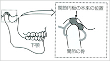 顎関節症