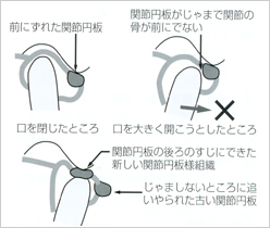 顎関節症